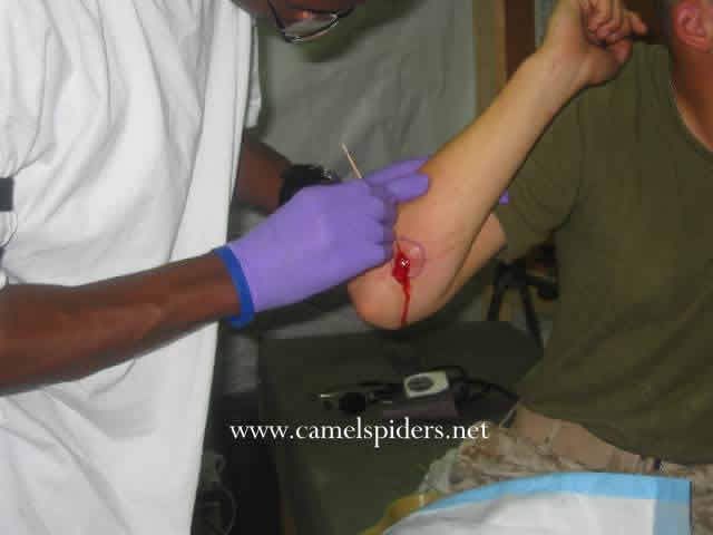 spider bites pictures on humans. Camel+spider+ites+human